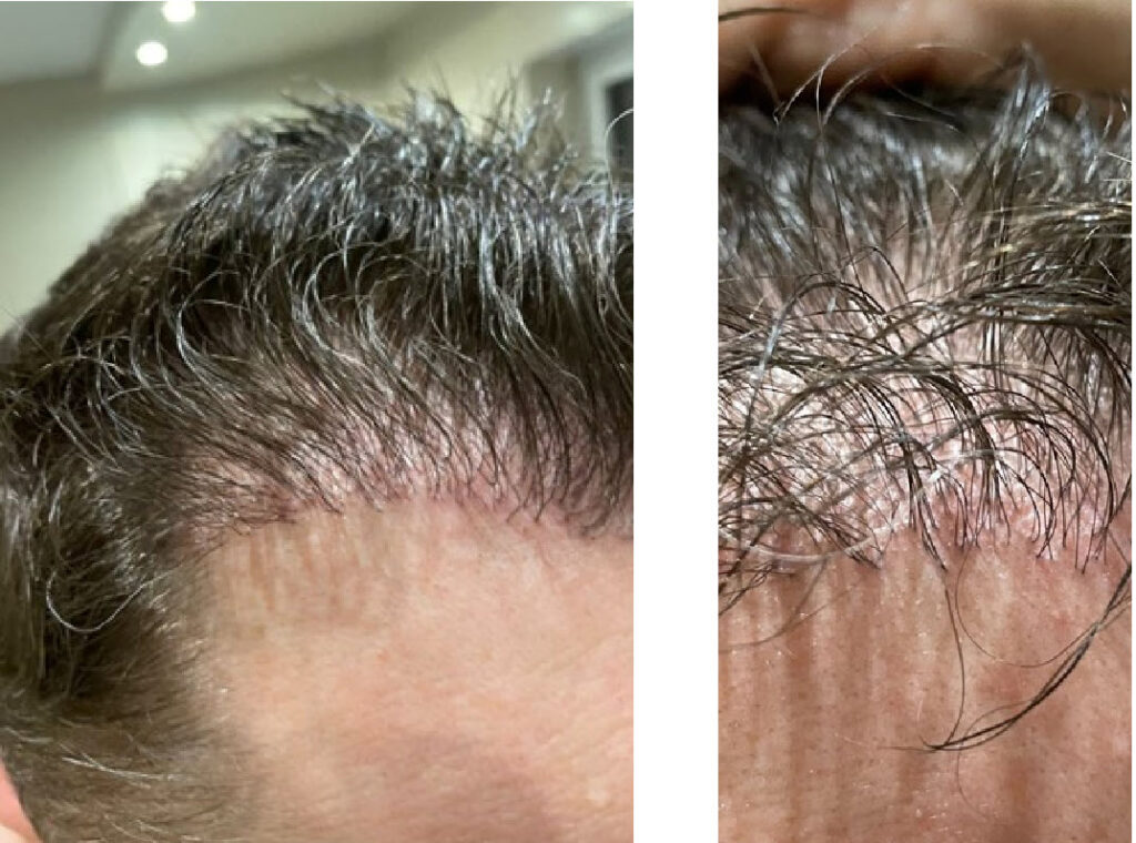 بعد عام من زراعة الشعر تركيا