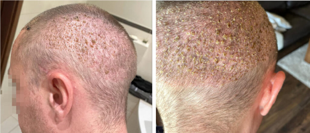 3 أسابيع بعد جراحة زراعة الشعر