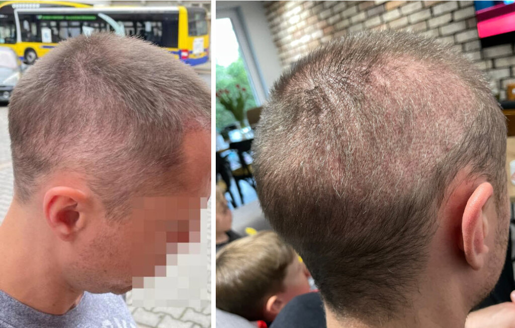 5 أشهر بعد زراعة الشعر منطقة مستنزفة