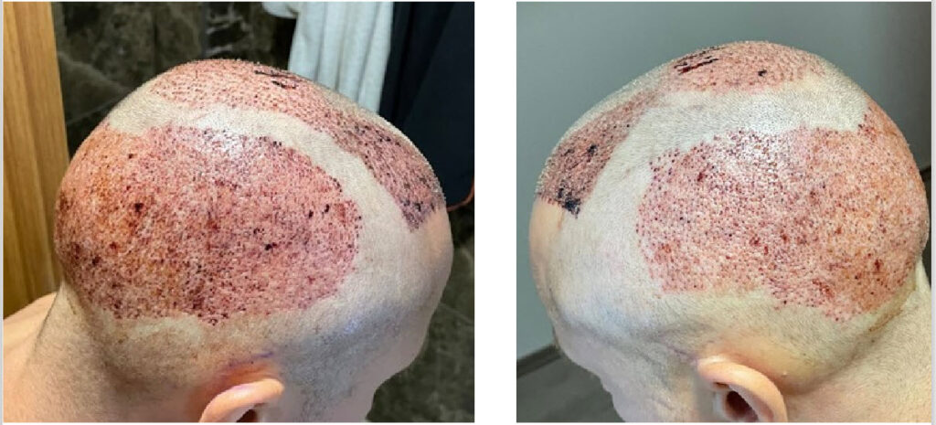 بعد زراعة الشعر تركيا