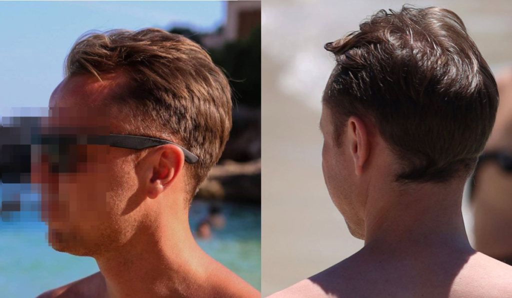 قبل زراعة الشعر