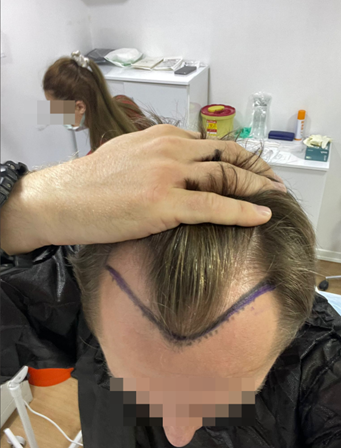 قبل زراعة الشعر في العيادة غير القانونية