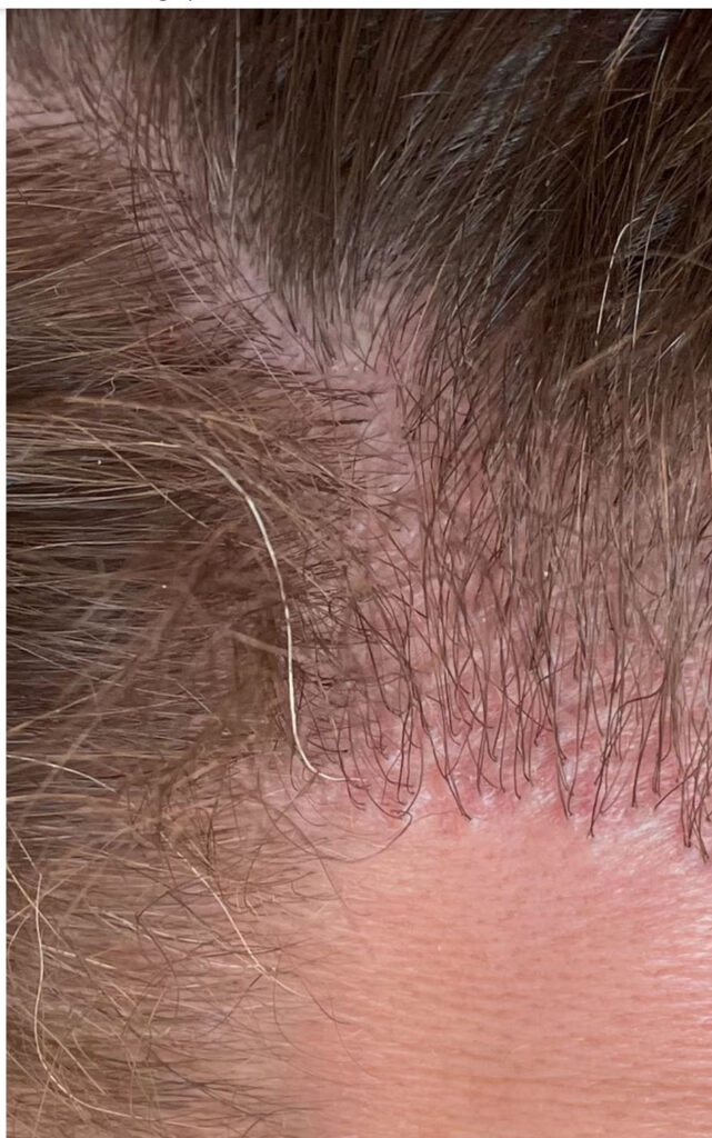 نتائج زراعة الشعر بعد عام السوق السوداء