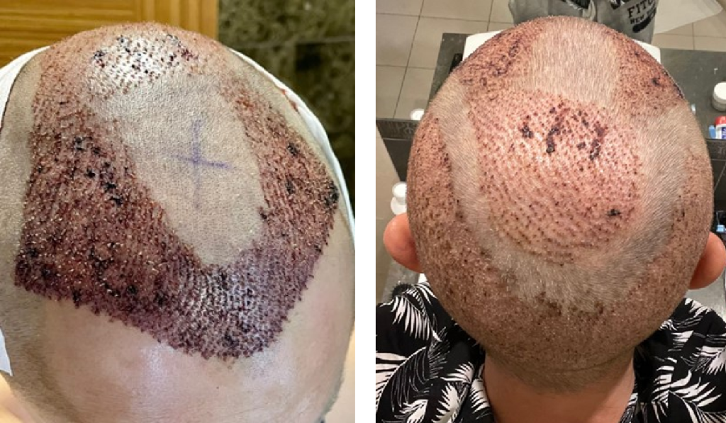 أسبوع واحد بعد جراحة زراعة الشعر تركيا
