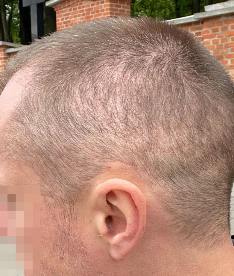 زراعة شعر بمنطقة مانحة مُستنزفة بشكل مفرط