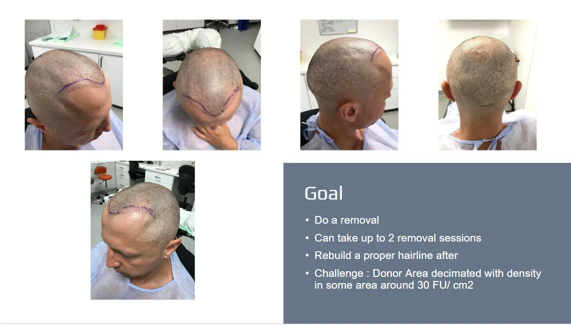 إصلاح زراعة الشعر